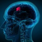 انواع تومورهای مغزی و نخاعی در بزرگسالان