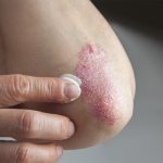 بیماری پوستی صدف یا پسوریازیس: دلایل و روش های درمان