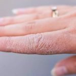 چه دلایلی باعث کنده شدن پوست دست ها می شود؟