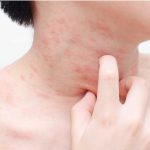 علائم و روش‌های درمانی موثر اگزمای پوستی +درمان خانگی